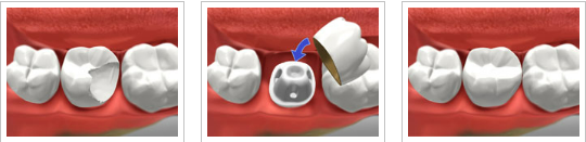 Same Day Crowns